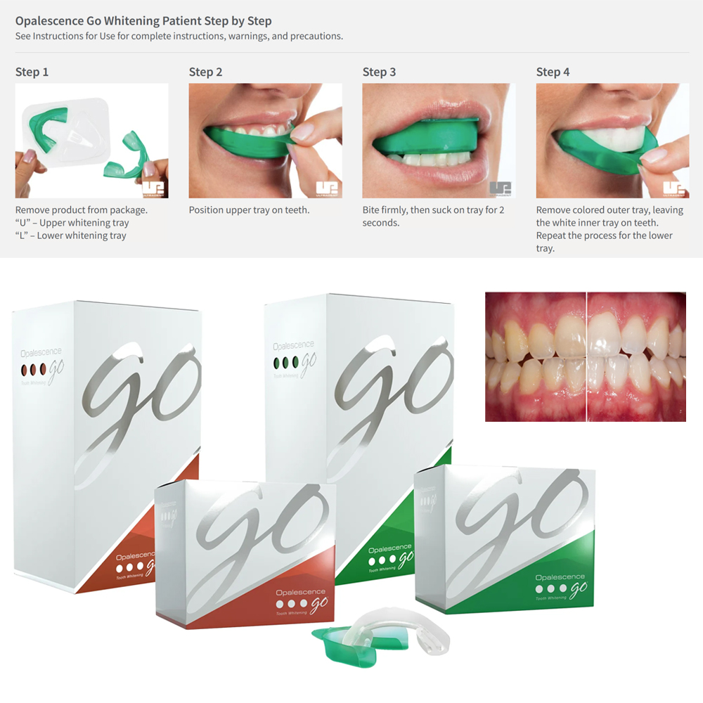 Teeth Whitening Home Kit - Opalescence Go Teeth Whitening Trays Prefilled
