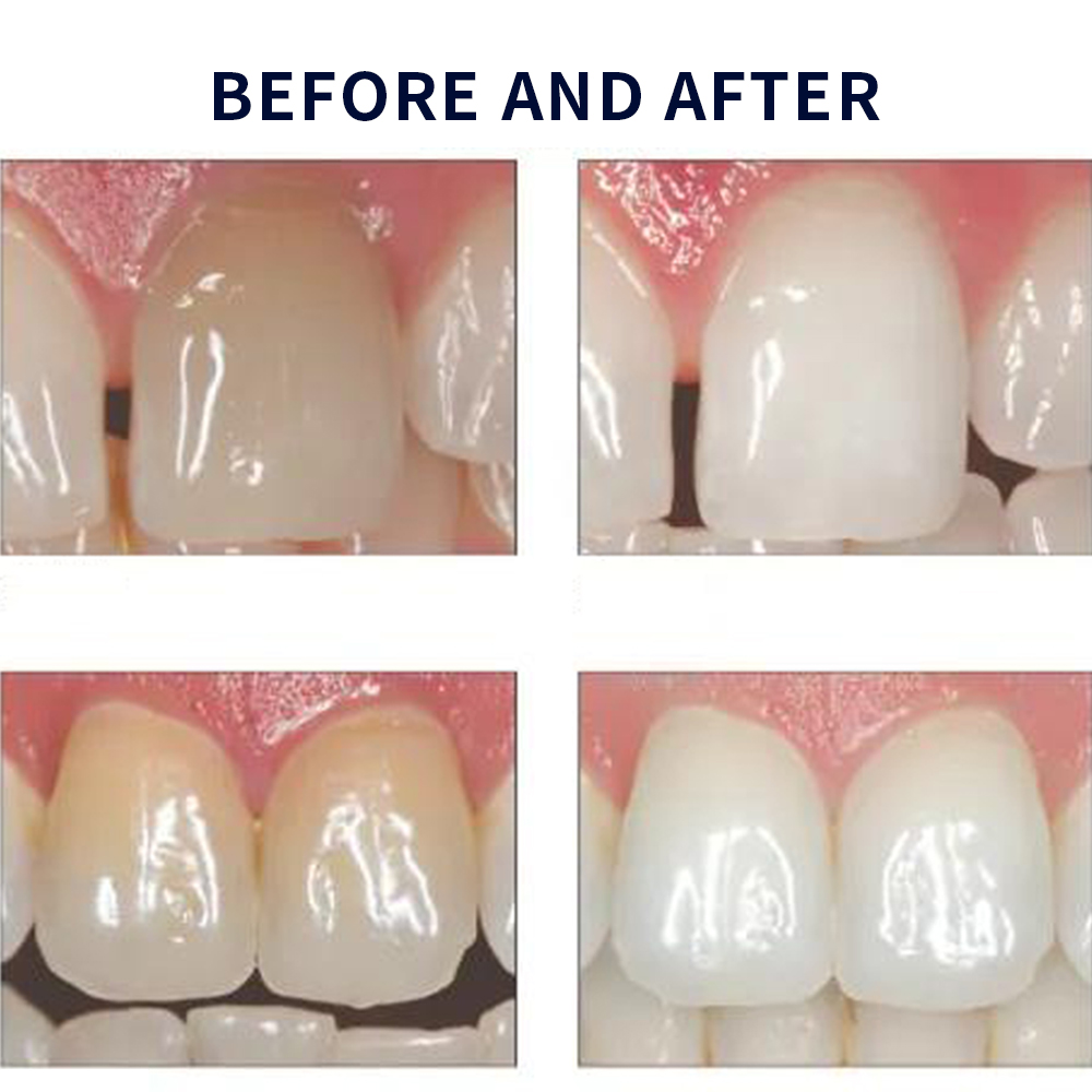 Opalescence Whitening 20% PF 2 - Teeth Whitening Home Kit 评论和价格
