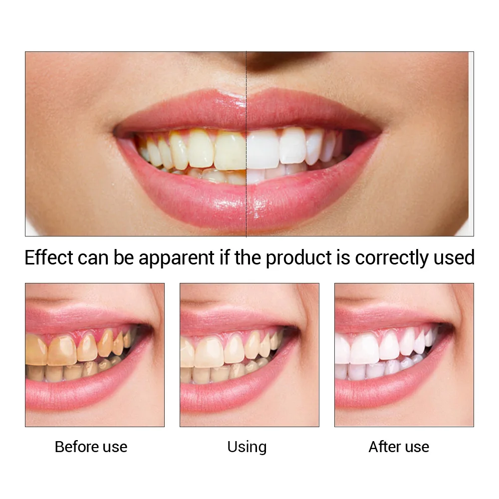 FTEENPLY Teeth Whitening Essen - Teeth Whitening Procedure 评论和价格