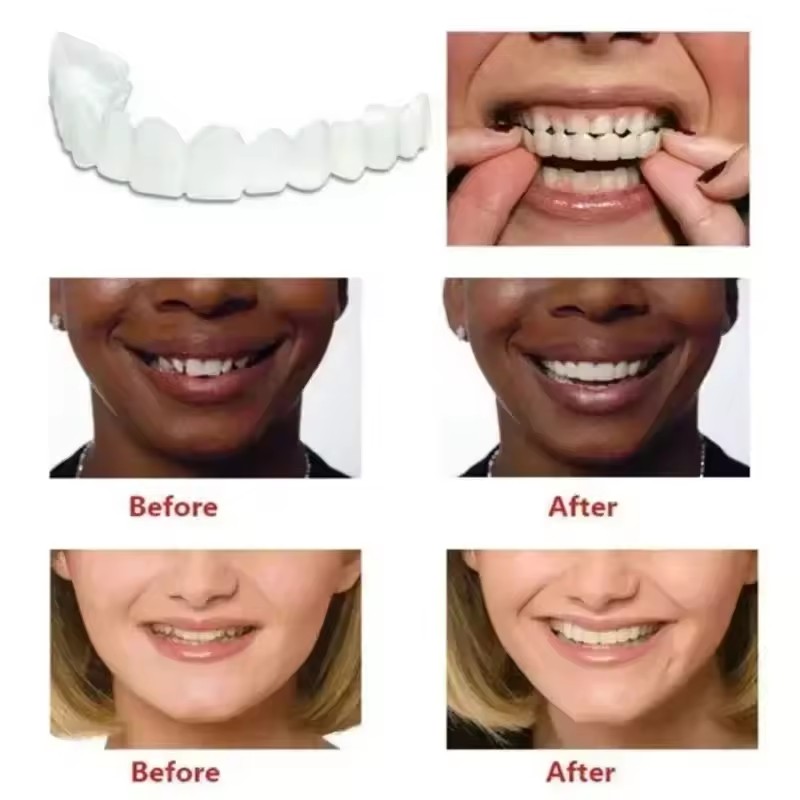 Teeth Veneers Whitening Dentur - Teeth Whitening Procedure 评论和价格