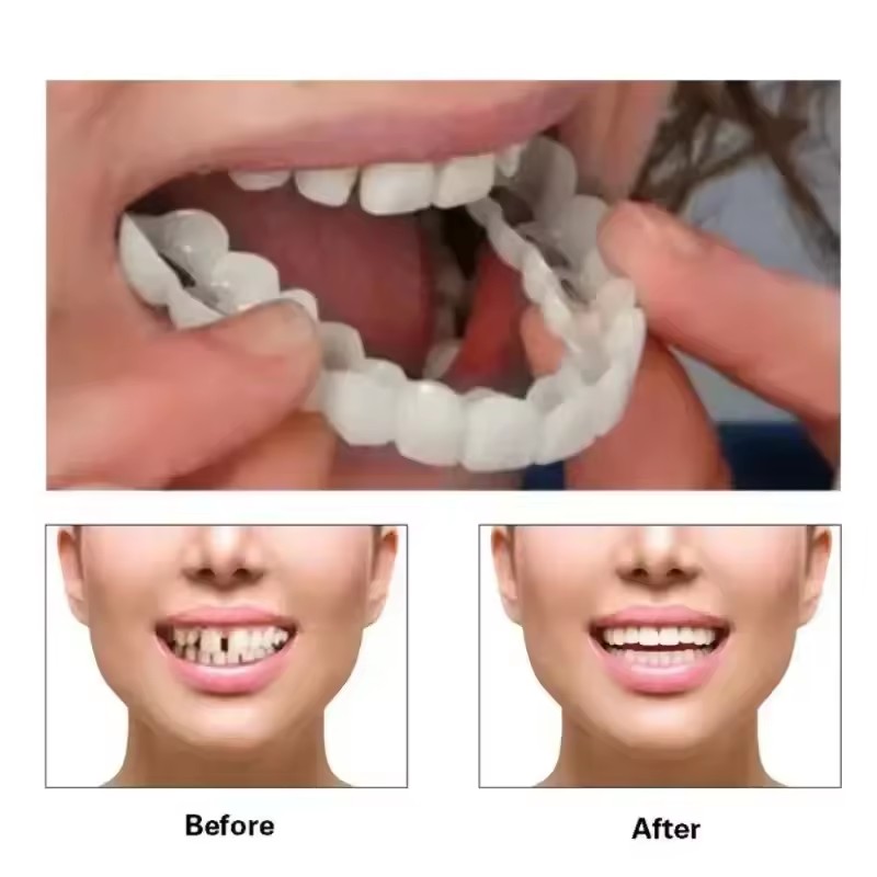 Teeth Veneers Whitening Dentur - Teeth Whitening Procedure 评论和价格