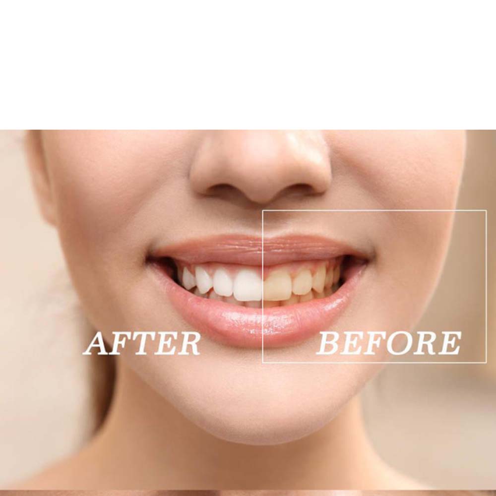 Top Quality Peroxide Teeth Whi - Teeth Whitening Bleaching Kit 评论和价格