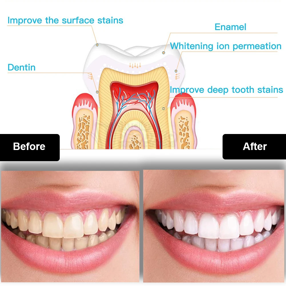Dental Teeth Whitening Kit Min - Teeth Whitening Procedure 评论和价格
